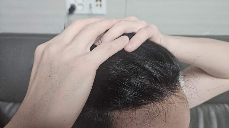 New Hair Seoul branch is in the 6th month of non-cut hair transplantation 1,200 hair follicles