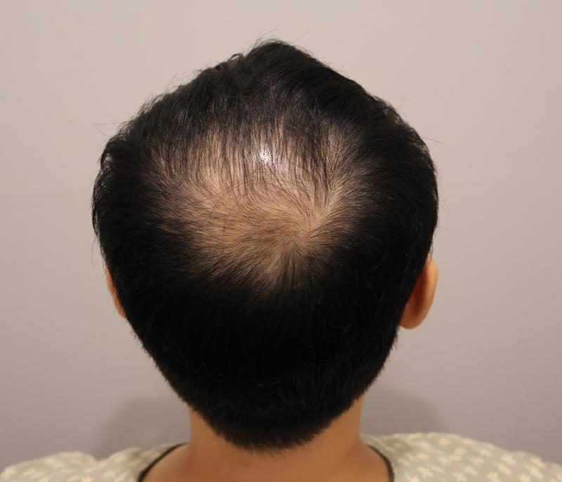 인천 마이모 비절개 1150모낭.