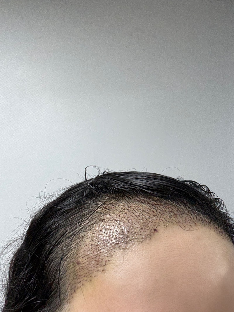 I had a reoperation at the Apgujeong Mo Woo-rim clinic