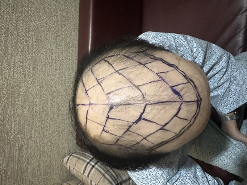 This is a review of the incision 2500 hair follicle transplantation.