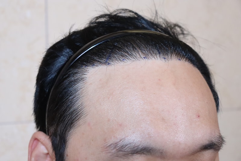 움찬의원 7천모 복합 수술 후기