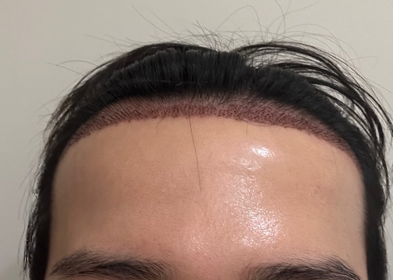 신논현 알파모의원 비절개 1000모 모발이식 당일 후기입니다