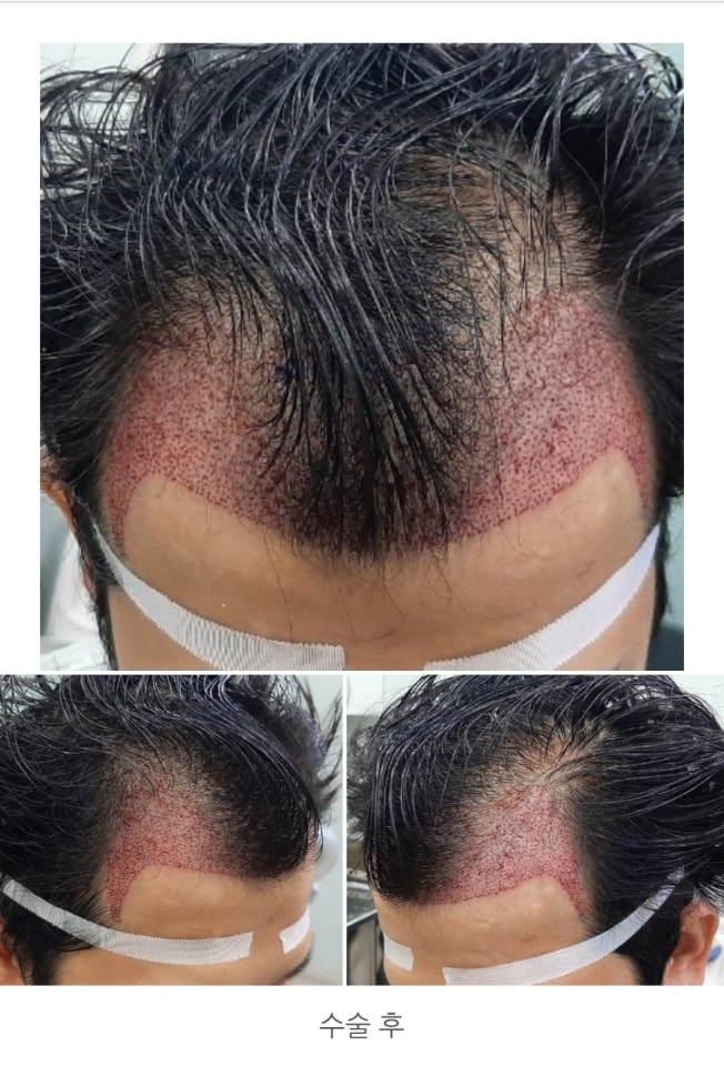 수술  경과37일차