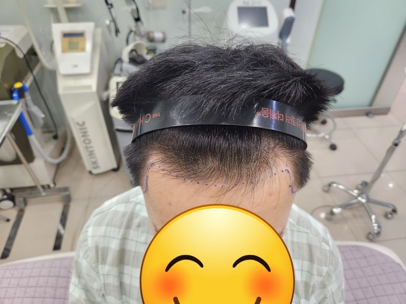 앞머리 구레나룻 1~7일차