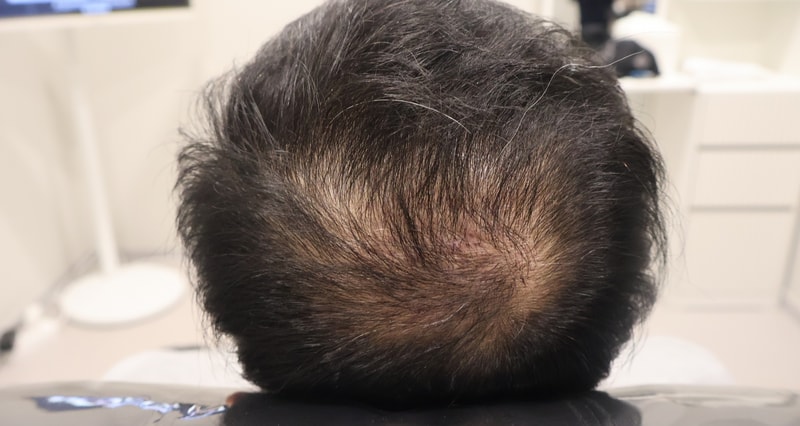 6개월차 후기 입니다.(인천 마이모의원)