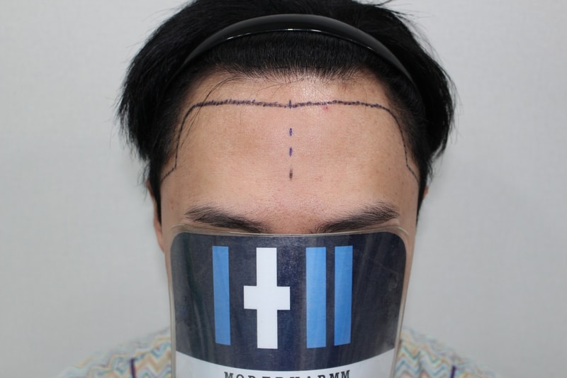 모더함 남성 엠자 측면 수술 다음날 후기입니다