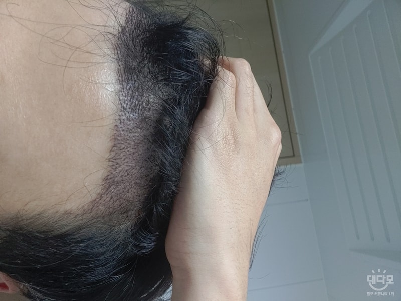 头发移植已经过了50天