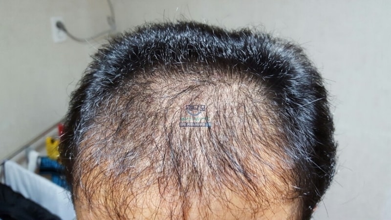 Non-cut 1800 hair follicles 2 years and 2 months