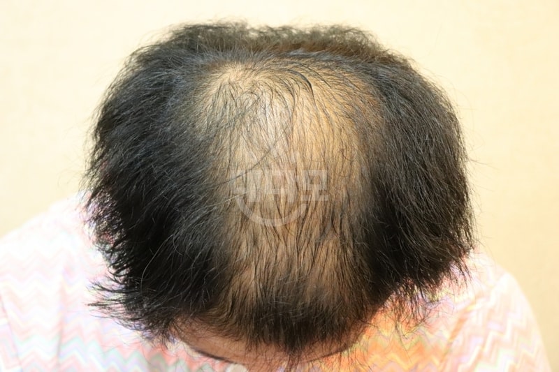 混合毛发移植1年后