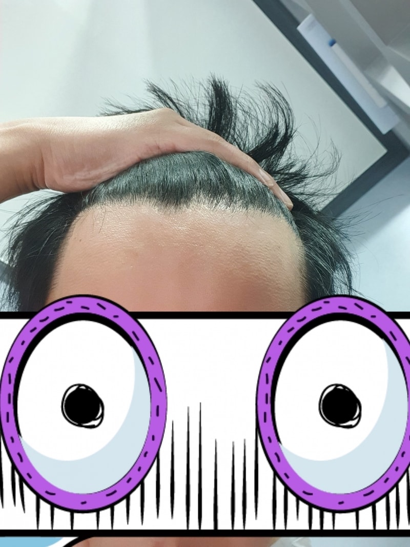 First-year review of M-shaped non-intersected hair transplantation