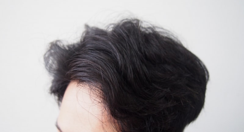 Maesung 1166 Hair follicle 14 months later (graduated)