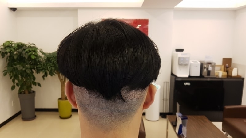 M字脱发 非接缝 毛发移植 (3600毛) 第二天