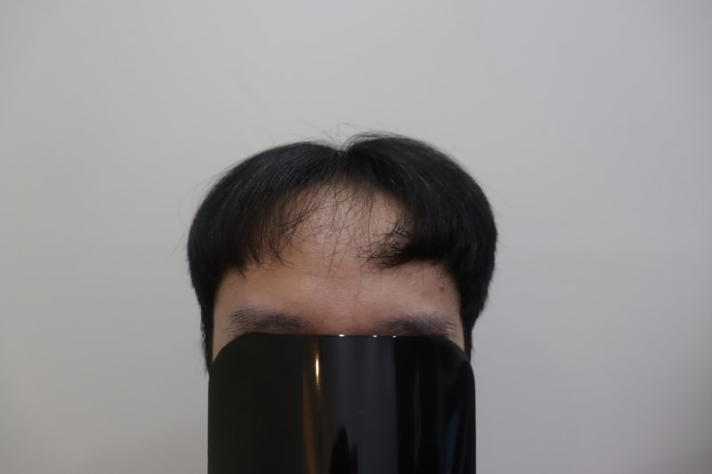 광주압구정모비앙의원 모발이식 1년 경과 후기