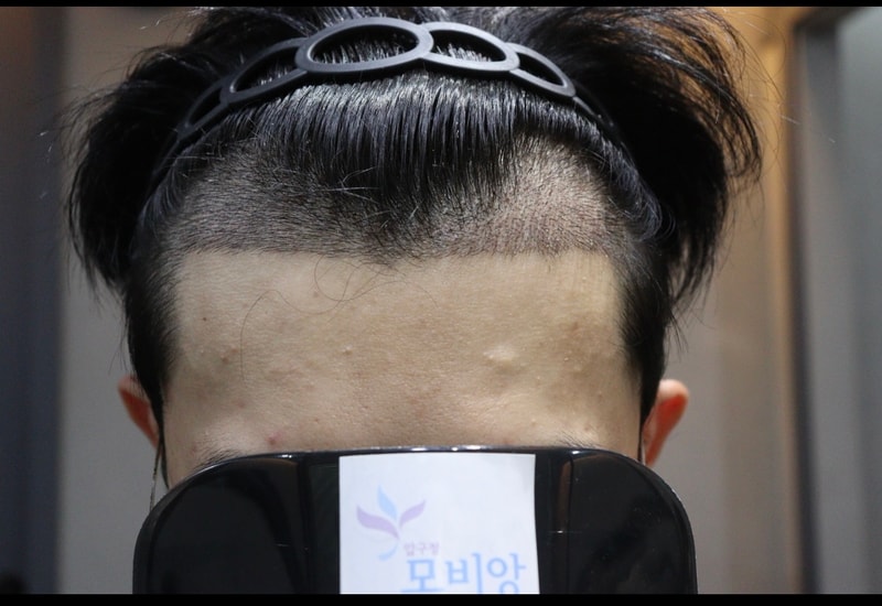 광주 압구정 모비앙의원 모발이식 2주 경과 후기