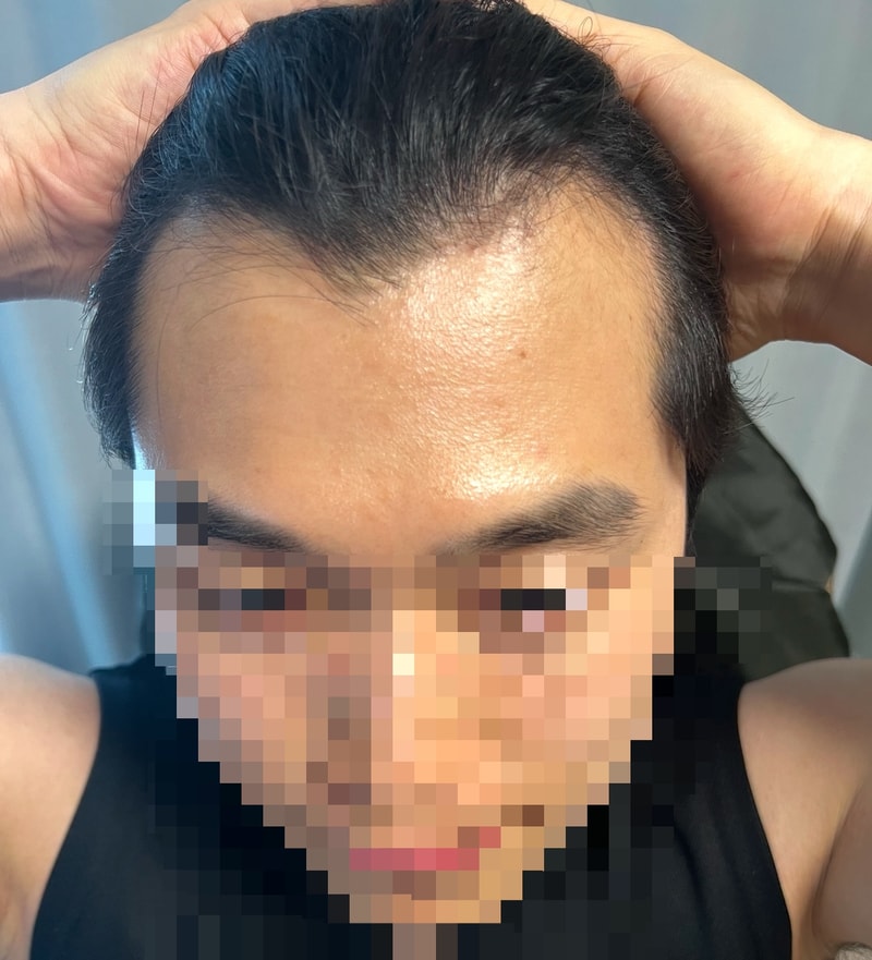 母材性整形外科の毛髪移植1日目の手術後のレビューを残します。