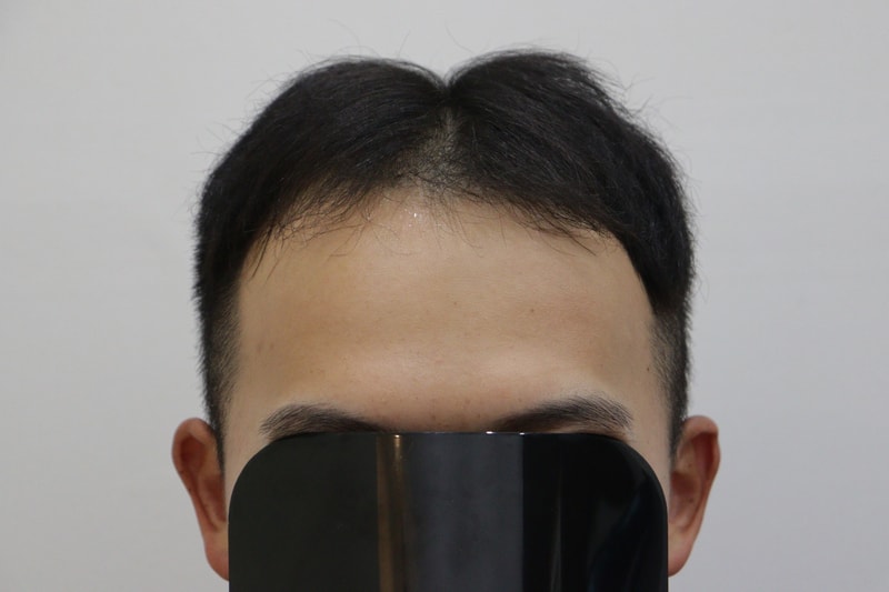 압구정모비앙 10개월경과 비절개 4700모