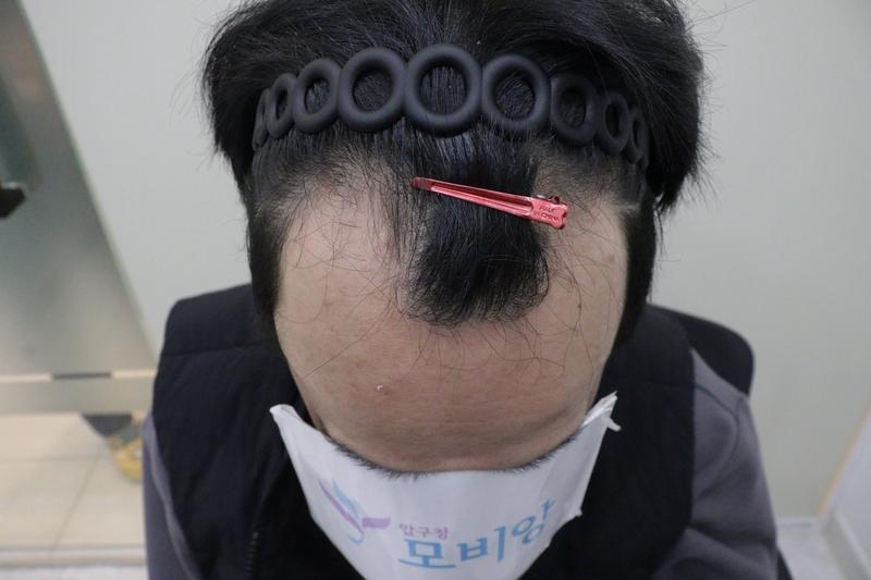 毛髪移植後