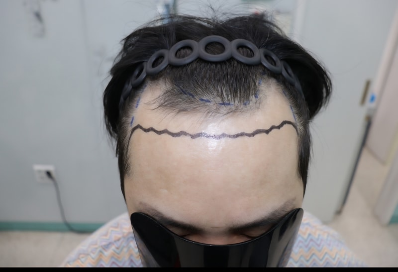 광주압구정모비앙의원6개월경과후기 안녕하세요 모발이식한지 벌써 6개월이 지났네요 6개월동안 도닦는심정으로 금연하구 술은 한달에 한두번 먹었습니다 음식도 최대한 인스턴트안먹을려고