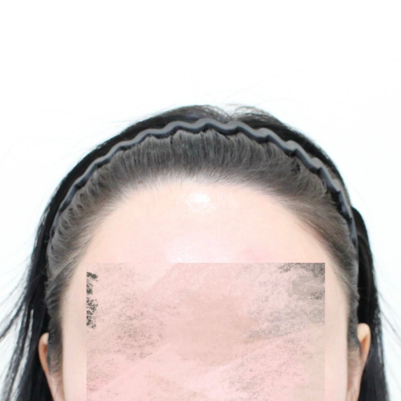 카우릭 헤어라인교정 + 구레나룻 1745모, 6개월 경과