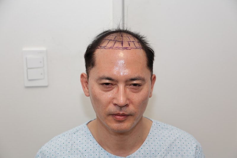 毛髪移植180日目。ニューヘアー