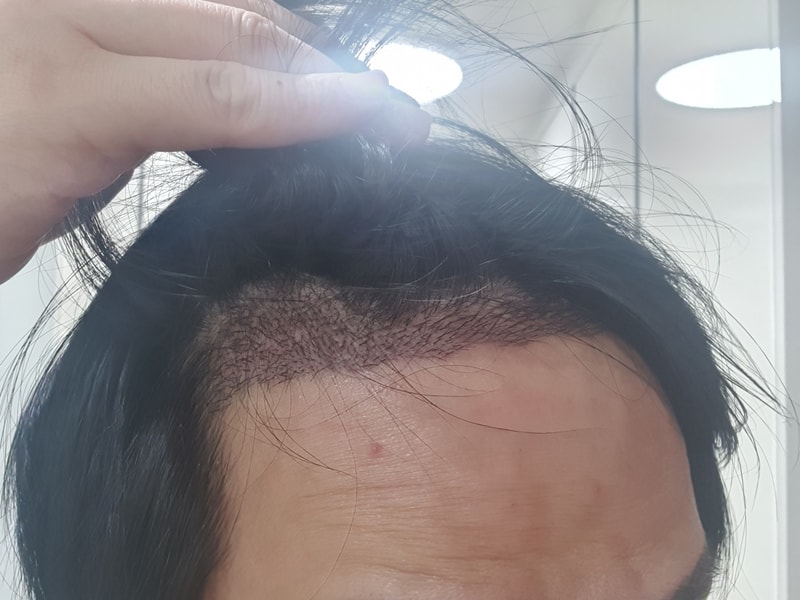 ついに手術14日目に触れることができます