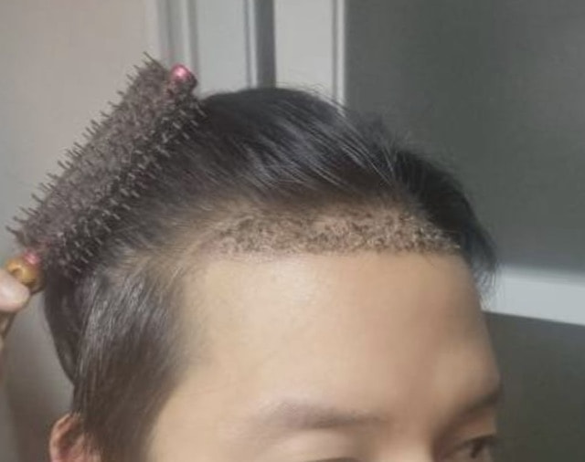 Forehead m-shaped hair loss non-cut hair transplant 1259 hair follicle fingerprint shampoo before and after