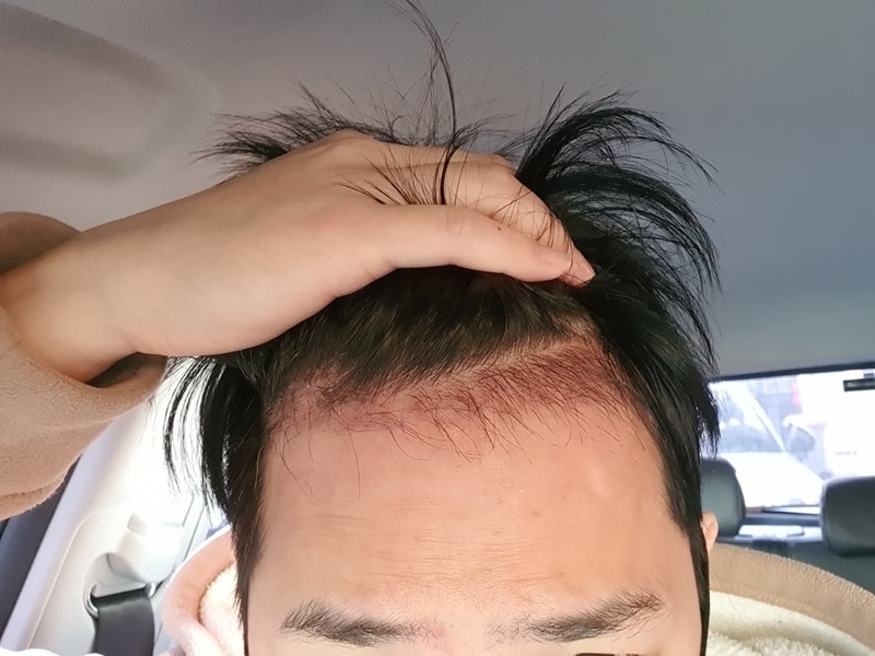 毛髪移植2ヶ月目です