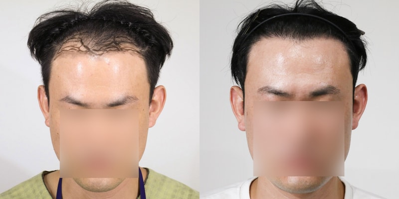 (third year) Rep. Mo Woo-rim's hairline + 4,500 hair incision (attached photo)