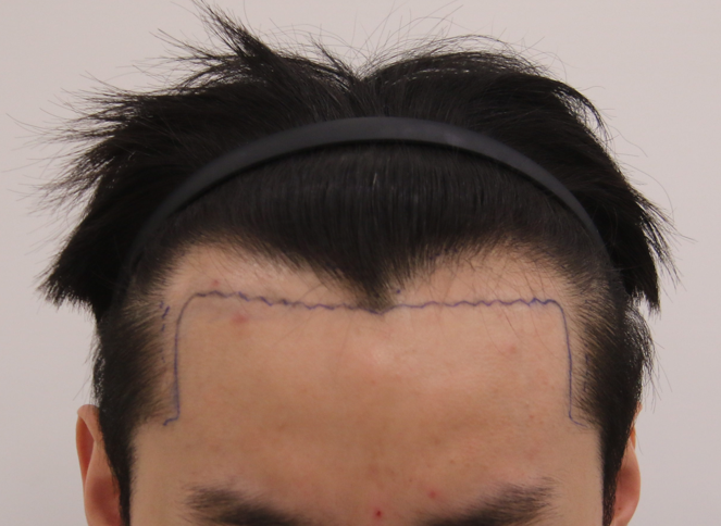 I finally solved my natural deep M-shaped hairline