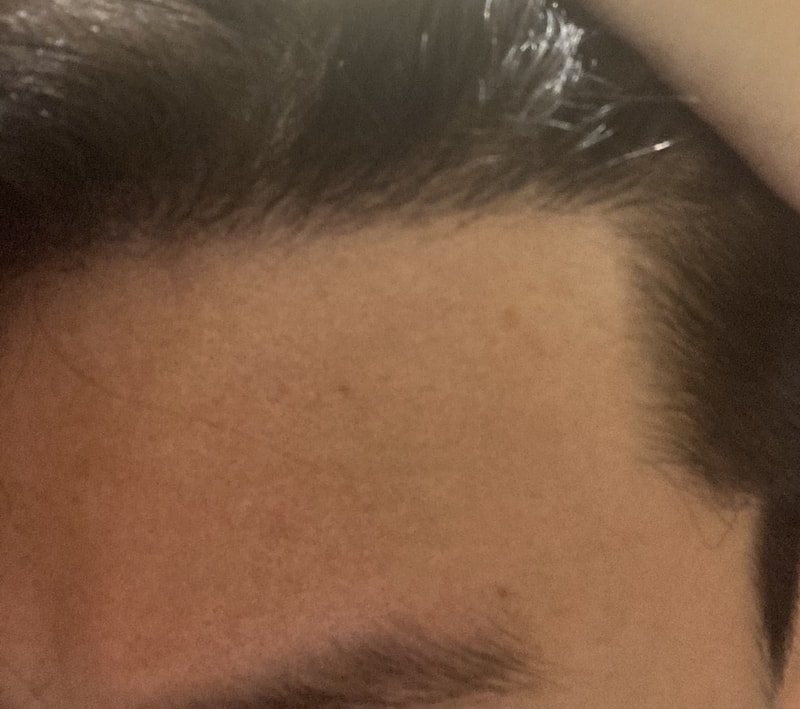 [Mo Jae-sung] Hairline 911 Hair Orang 8 Months Review