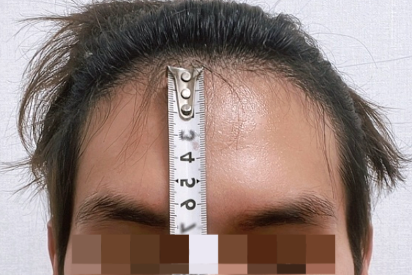 It's the 199th day of DA M-shaped male hair transplantation.