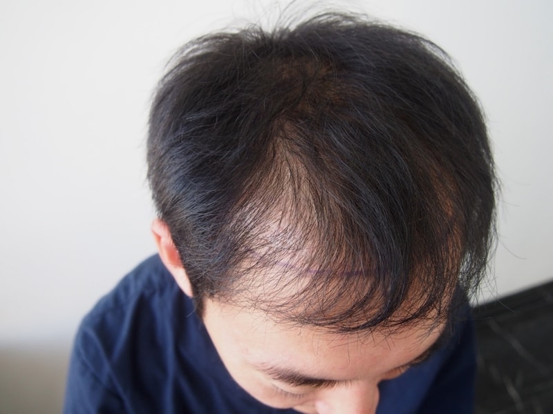 On November 30th, 4,000,000 hair transplants were made 2050 hair follicles