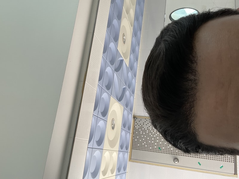 10th Month of Hair Transplantation Review
