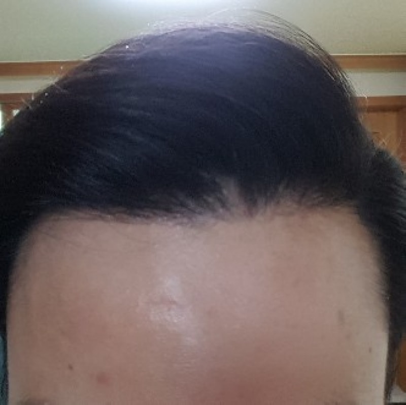 母材性非切開部分削髪1319毛包手術12ヶ月目の後期です。