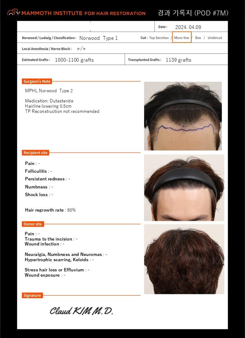 7 months have passed since M-shaped hair transplant in Busan