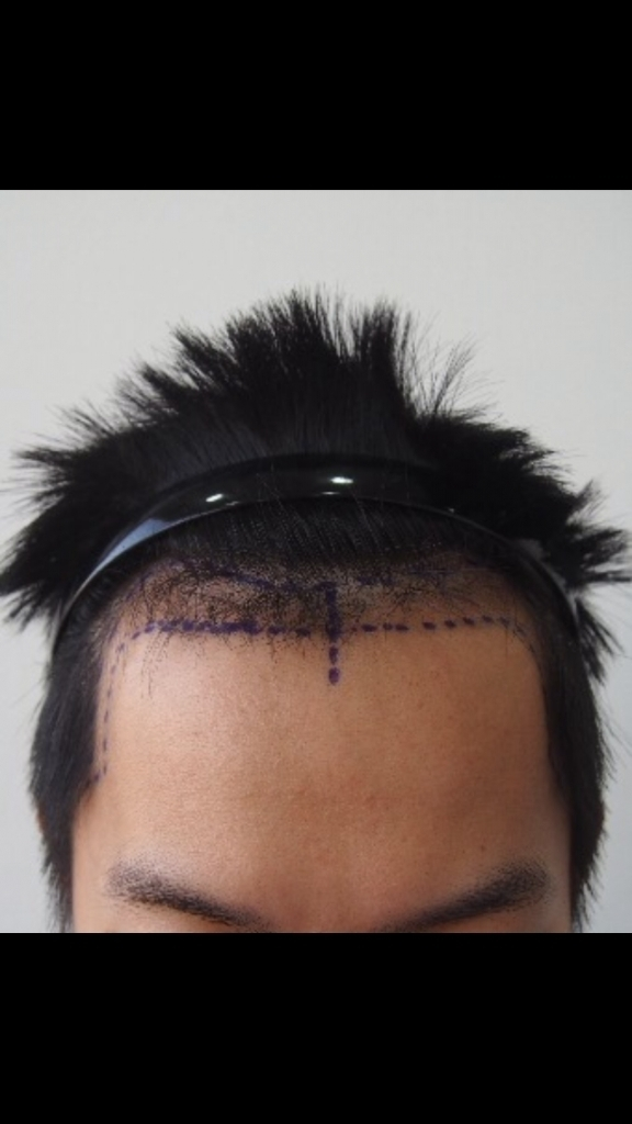Post-mortem Non-Cutting 1166 Hair follicle Transplantation