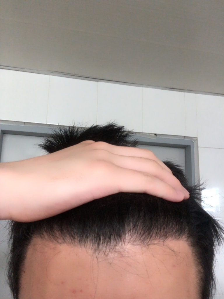 正しい移植7ヶ月目のレビュー
