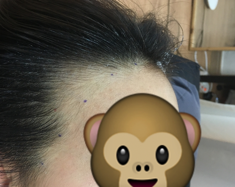 ヘアラインタトゥーよりヘアライン矯正をおすすめします