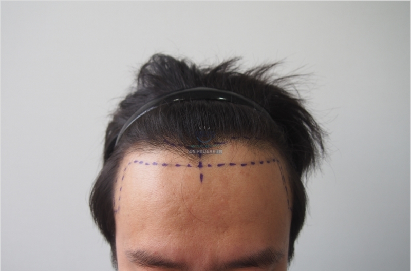 14 months after maternal non-cut 1490 hair follicle surgery (last)