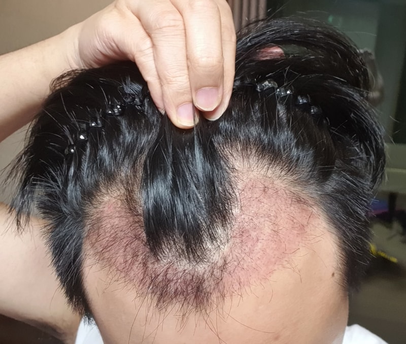 [Non-cut / 1600 hair follicles 30/60/80 Day] - NHI New Hair