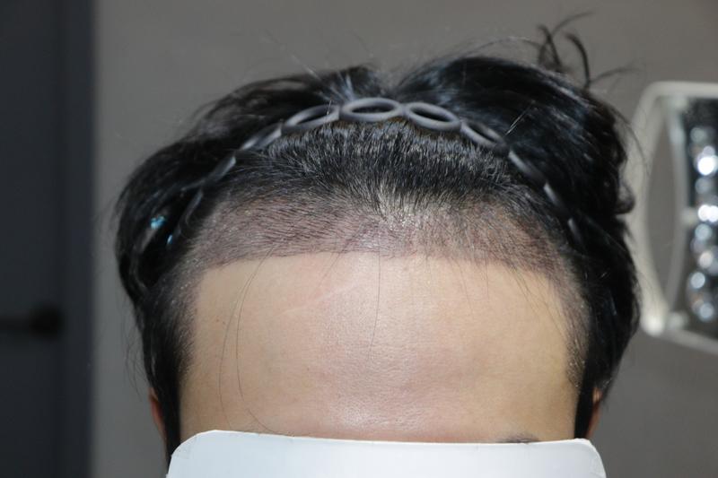광주 압구정 모비앙의원 모발이식 10일차 경과 후기
