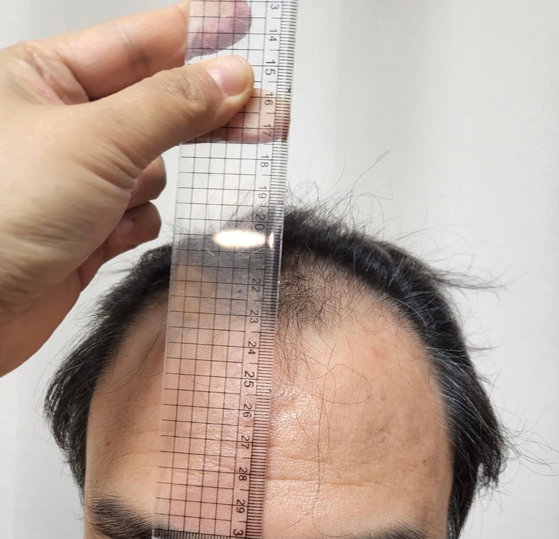 Dana Plastic Surgery Hair Transplantation 3300 Hair follicles Late stage