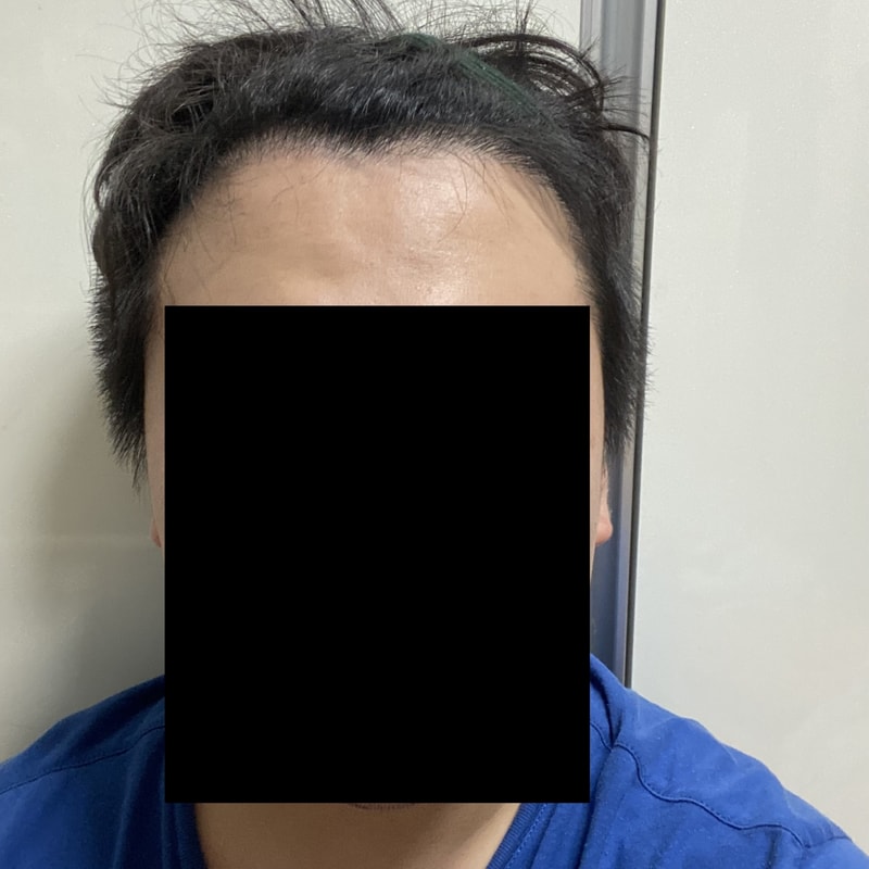 Dana M型毛发移植 4个月长得很好