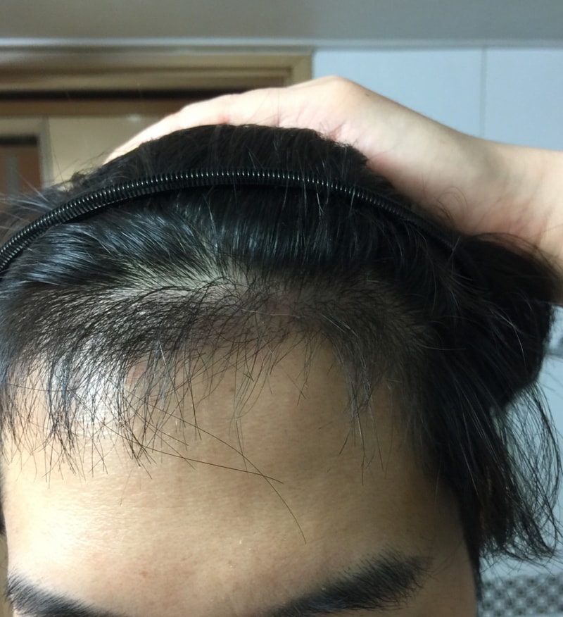 100 days of 1,000 hair follicle incision