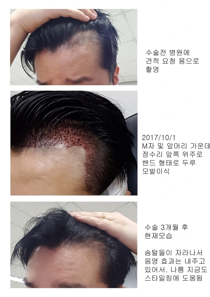 Late 3 months of hair transplantation 4,000 hair incision