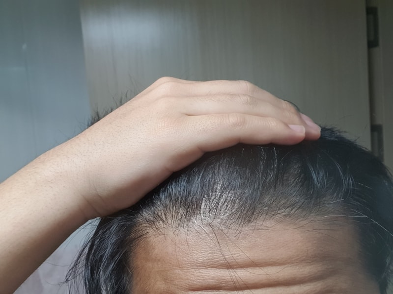 头发移植经过了一年
