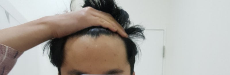 今天移植了头发。 请帮我看一下密度