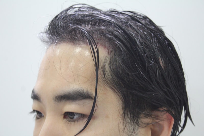 수술직후 17.JPG