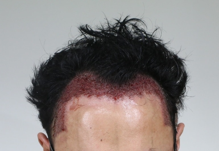 수술 후 1.jpg