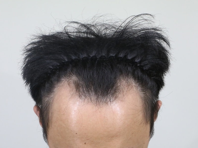 수술 전 2.jpg